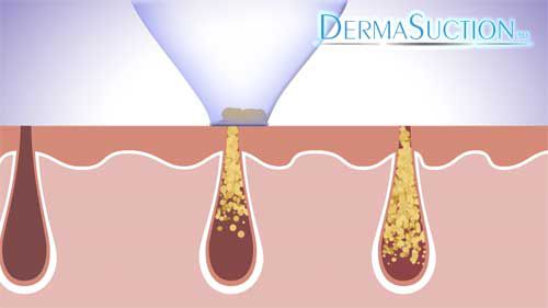 dermasuction-3 DermaSuction elimina puntos negros. Teletienda Botopro
