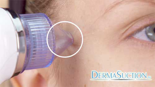 dermasuction-4 DermaSuction elimina puntos negros. Teletienda Botopro